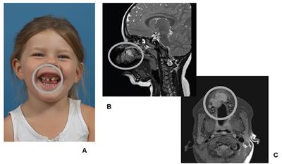 Reconstruction of a Subtotal Maxillectomy Defect Using a Customized Titanium Implant in a 4-Year-Old Child: An 8-Year Follow-Up Report